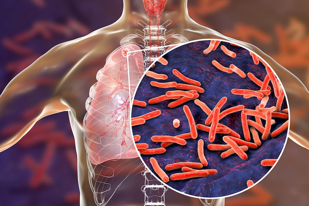 EMERGENCY HERBAL RESPONSE FOR: Tuberculosis Outbreak